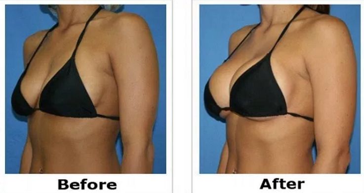 how to increase breast size 
